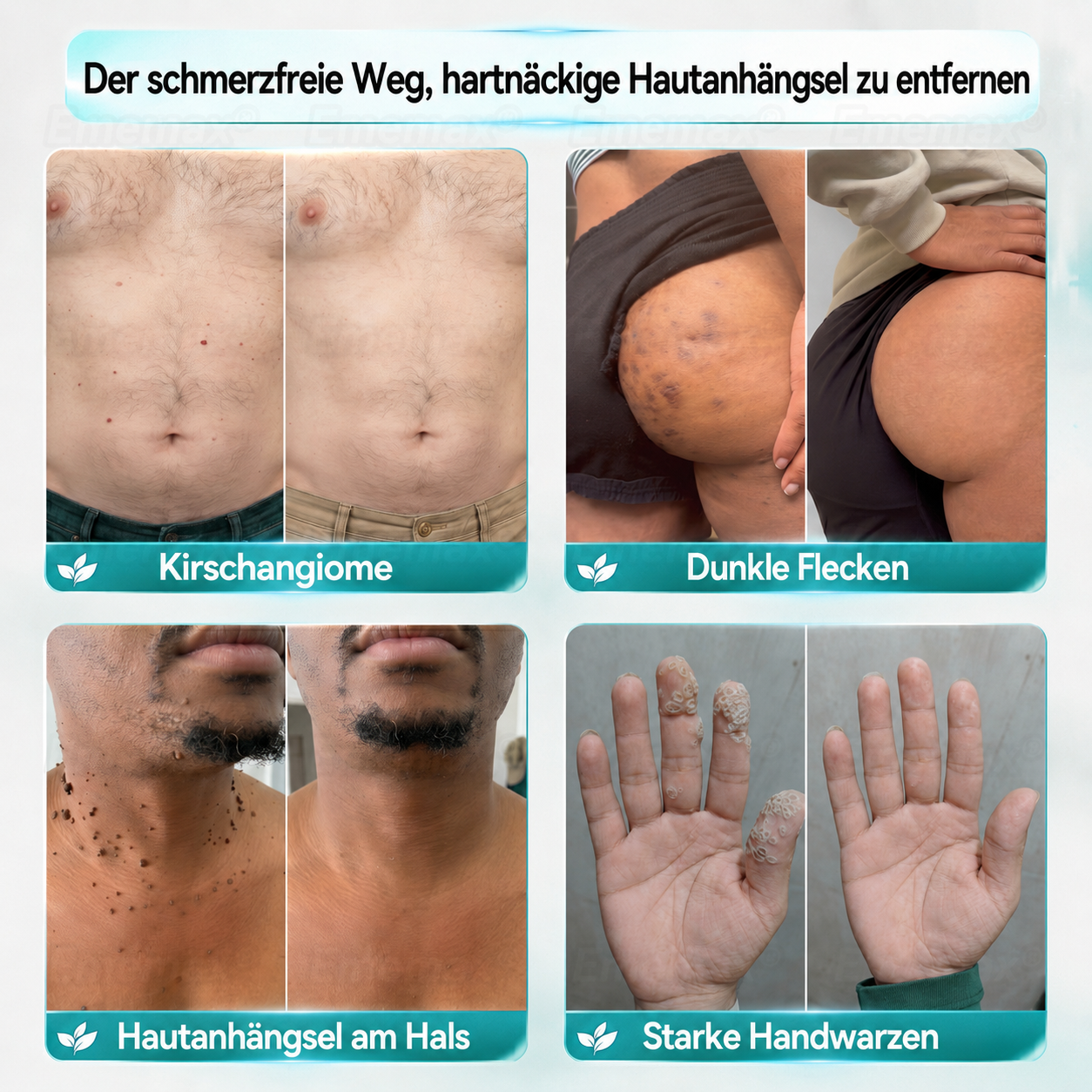 ✨👌𝐄𝐦𝐞𝐦𝐚𝐱®𝟐-𝐢𝐧-𝟏 𝐌𝐢𝐤𝐫𝐨𝐧𝐚𝐝𝐞𝐥- & 𝐇𝐲𝐝𝐫𝐨𝐤𝐨𝐥𝐥𝐨𝐢𝐝-𝐌𝐮𝐭𝐭𝐞𝐫𝐦𝐚𝐥-𝐄𝐧𝐭𝐟𝐞𝐫𝐧𝐮𝐧𝐠𝐬𝐩𝐟𝐥𝐚𝐬𝐭𝐞𝐫 (𝐍𝐮𝐥𝐥 𝐒𝐜𝐡𝐦𝐞𝐫𝐳𝐞𝐧, 𝐍𝐮𝐥𝐥 𝐍𝐚𝐫𝐛𝐞𝐧 𝐏𝐟𝐥𝐚𝐬𝐭𝐞𝐫)