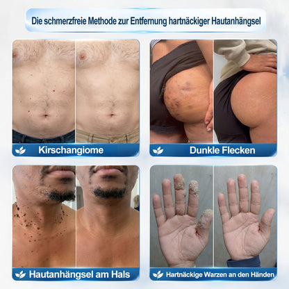 Offizieller Markenstore |✅𝑷𝑖𝒄𝐝𝐨® 🍁💖7-𝑻𝒂𝒈𝒆 𝑯𝒂𝒖𝒕𝒂𝒏𝒉ä𝒏𝒈𝒔𝒆𝒍- & 𝑭𝒍𝒆𝒄𝒌𝒆𝒏𝒆𝒏𝒕𝒇𝒆𝒓𝒏𝒆𝒓(Schmerzfreier Rollerball – Keine Narbenbildung)